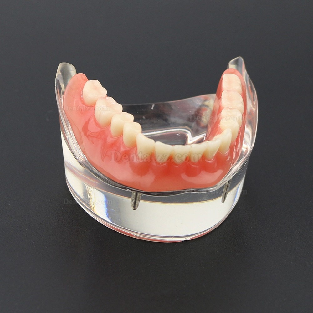 歯科下顎重塁教学用義歯モデル模型 2本インプラント6002 01